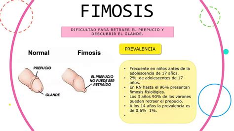 fimosis foto|Image:Phimosis